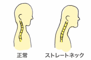 通常の首とストレートネック